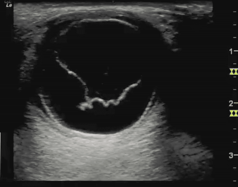 Vision Loss & Ultraosound | POCUS Case Studies | POCUS.org