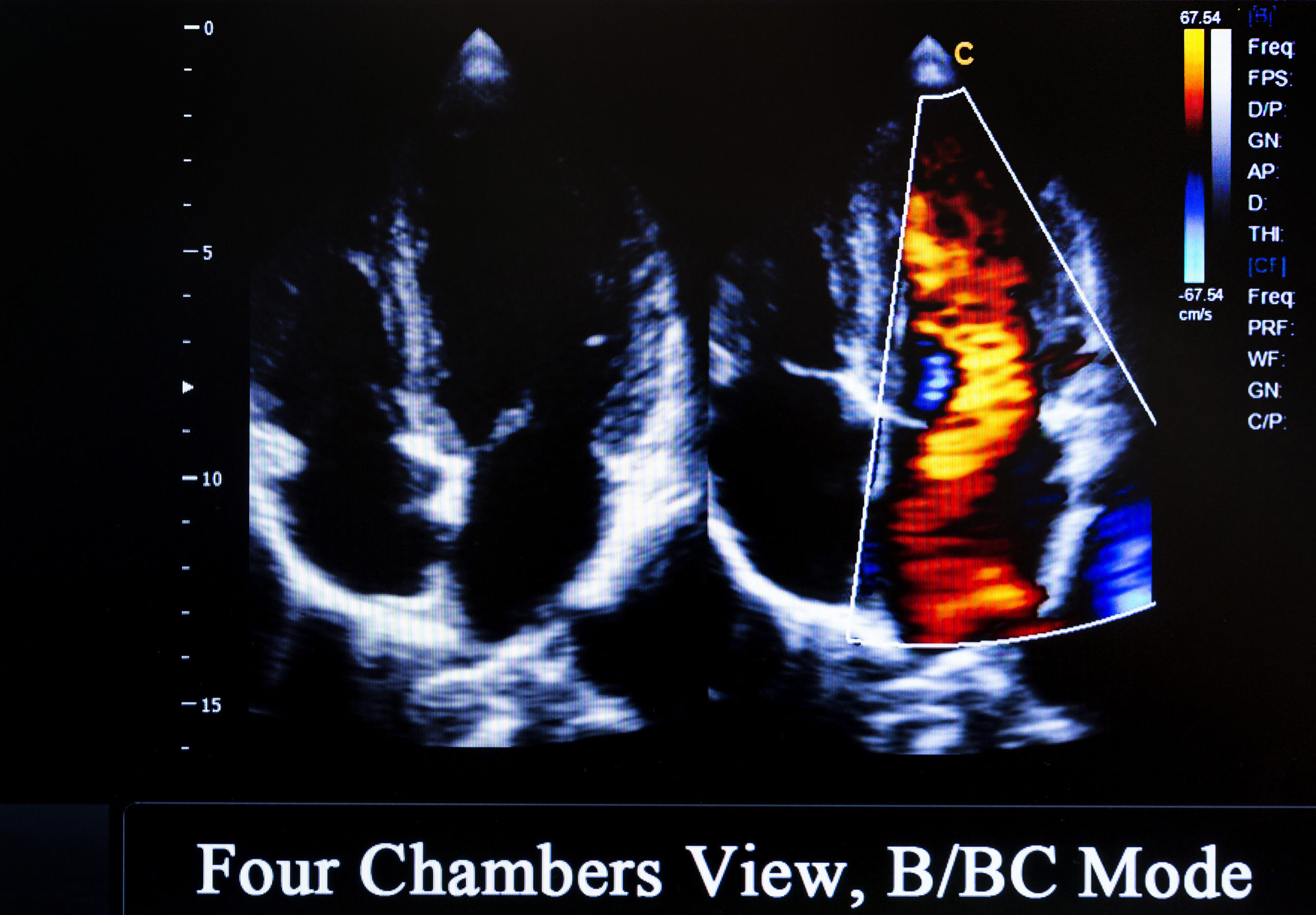 Image showing the four-chamber view. RV with the moderator band