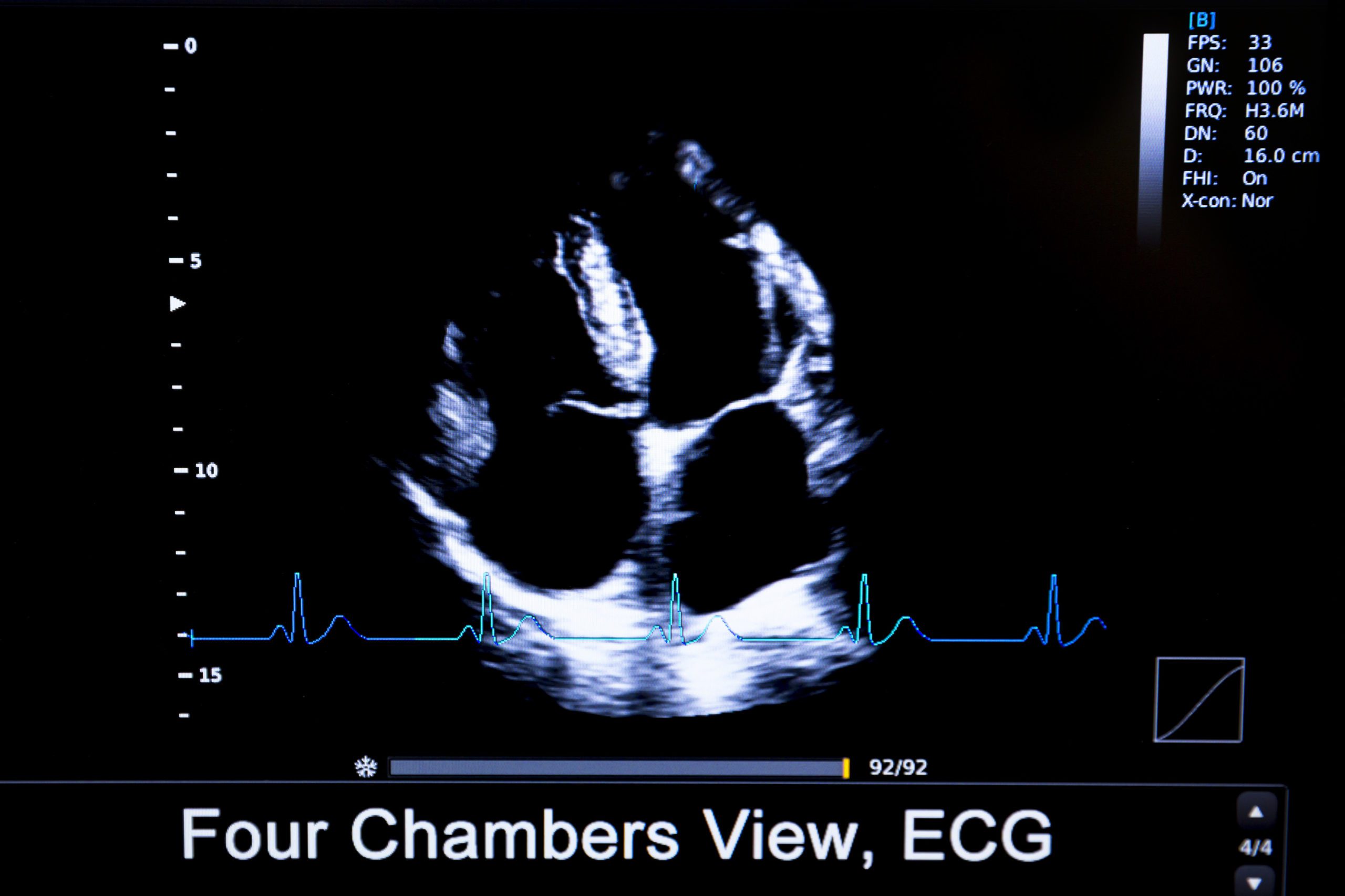 Image showing the four-chamber view. RV with the moderator band