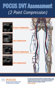 two point dvt pocus exam infogram