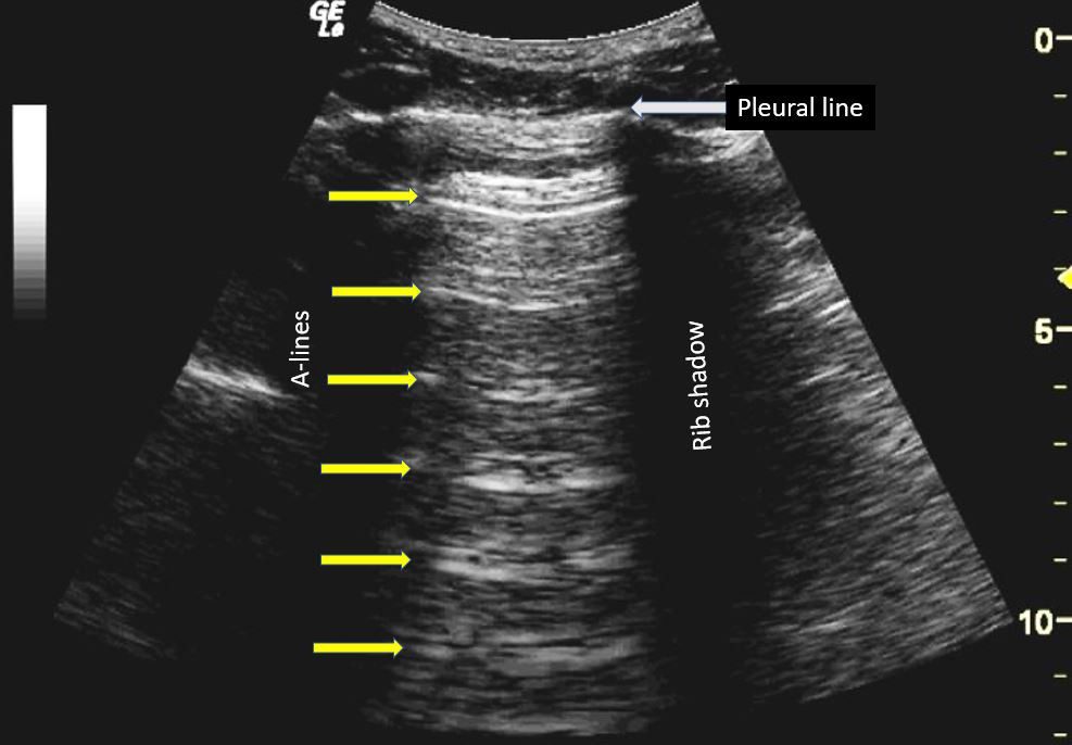 COVID19 and the Role of Point of Care Ultrasound