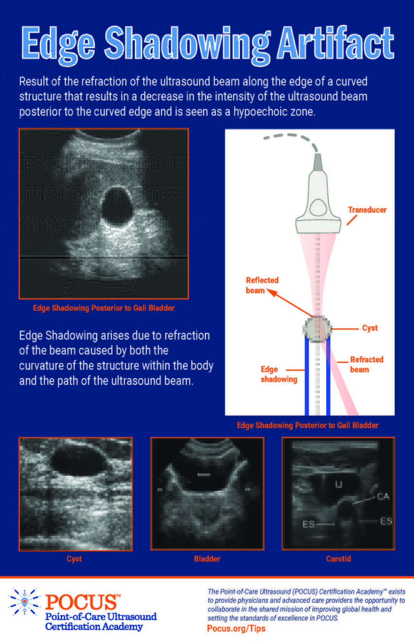 Edge Shadowing Artifact POCUS Resources & Case Studies