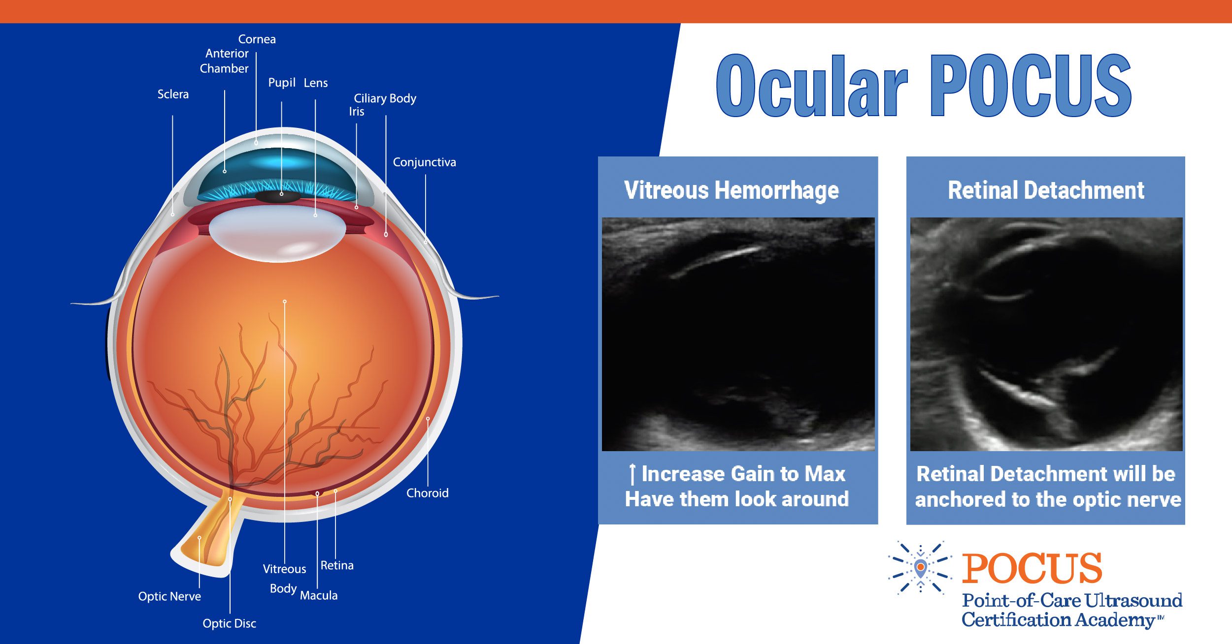 ocular-pocus-pocus-resources-case-studies-pocus