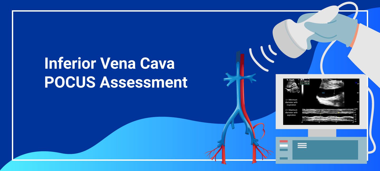 Inferior Vena Cava POCUS Assessment of Inferior Vena Cava (IVC)