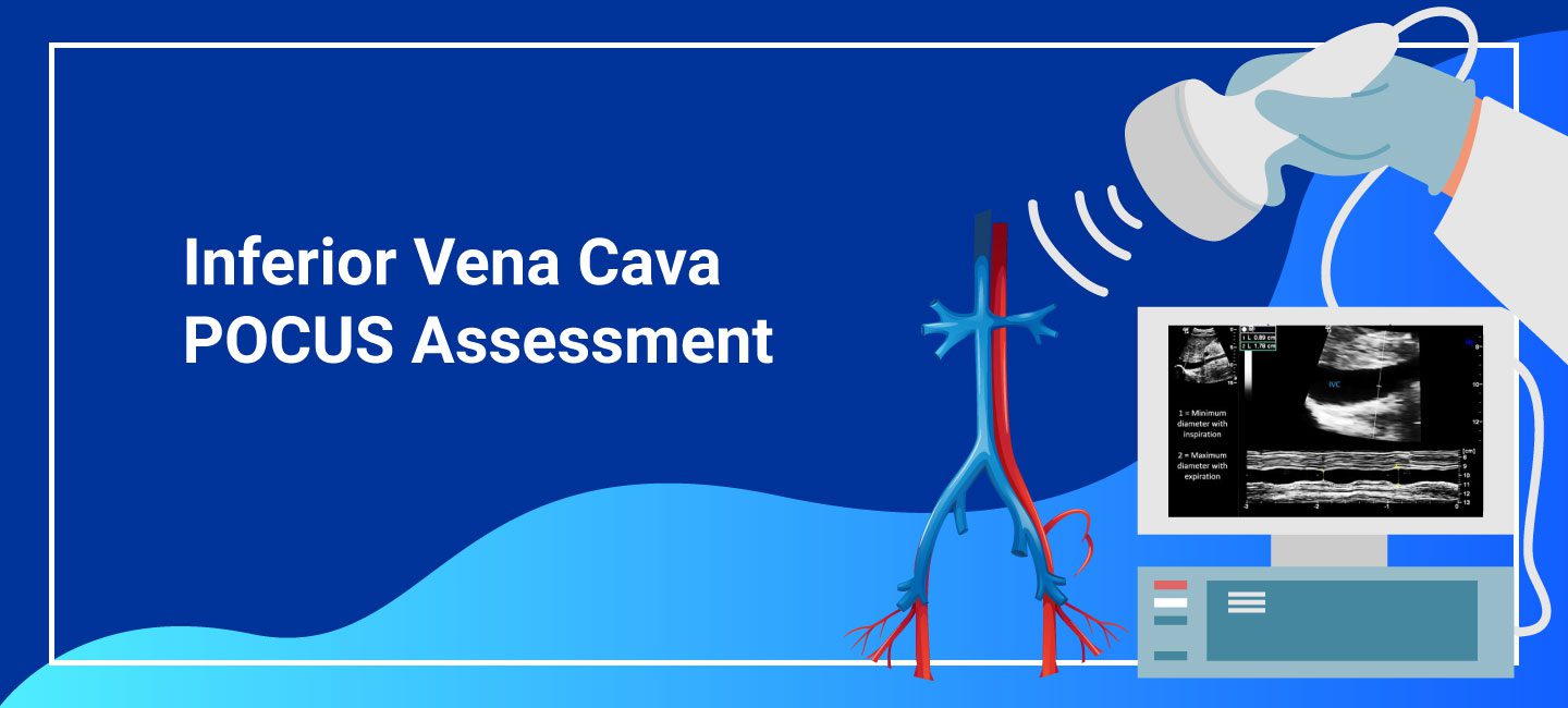 Inferior Vena Cava POCUS Assessment of Inferior Vena Cava (IVC) Point