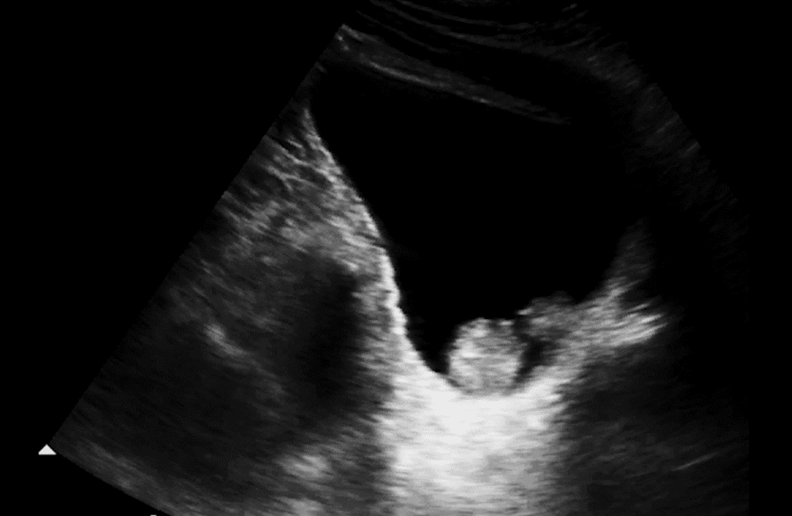 Mitral Valve Flow Analysis with Color Doppler | Case Studies | POCUS.org