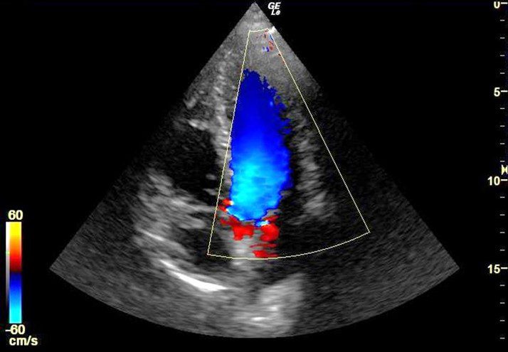 Color Doppler - Left Heart, Case Studies