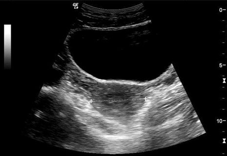 Fig 1. Transverse view of the urinary bladder. The uterus is seen posteriorly. 