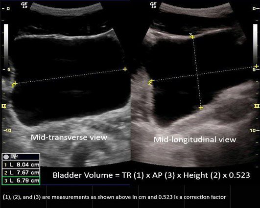 Fig 2. Bladder volume calculation using the ellipse method.