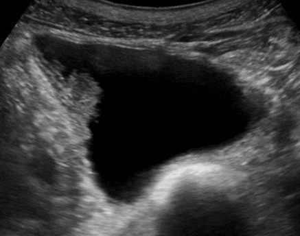 Fig 3. Bladder mass. Image courtesy of UltrasoundCases.info owned by SonoSkills. 