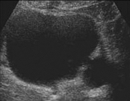 Fig 4. A small bladder diverticulum is seen arising from the defect in the bladder wall—image courtesy of UltrasoundCases.info owned by SonoSkills. 