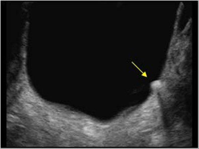 Fig 5. Single bladder calculus. Image courtesy of UltrasoundCases.info owned by SonoSkills. 