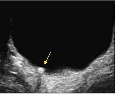 Fig 6. Bladder calculus shifted position when the patient was rolled onto the right side—image courtesy of UltrasoundCases.info owned by SonoSkills. 