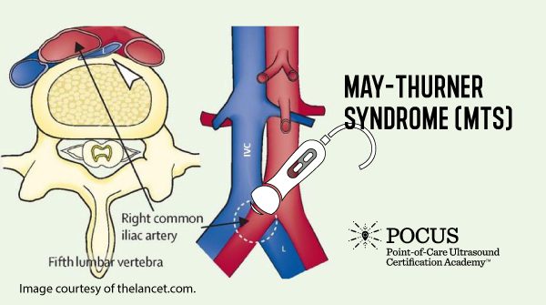 May-Thurner Syndrome (MTS)