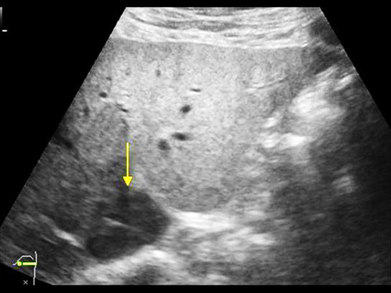 A static ultrasound image of a hypoechoic caudate lobe of a liver. A yellow arrow points to the caudate lobe of the liver.