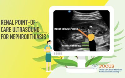 Renal Point of Care Ultrasound (POCUS) for Nephrolithiasis