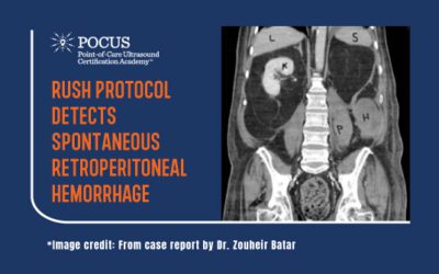 RUSH Protocol Detects Spontaneous Retroperitoneal Hemorrhage