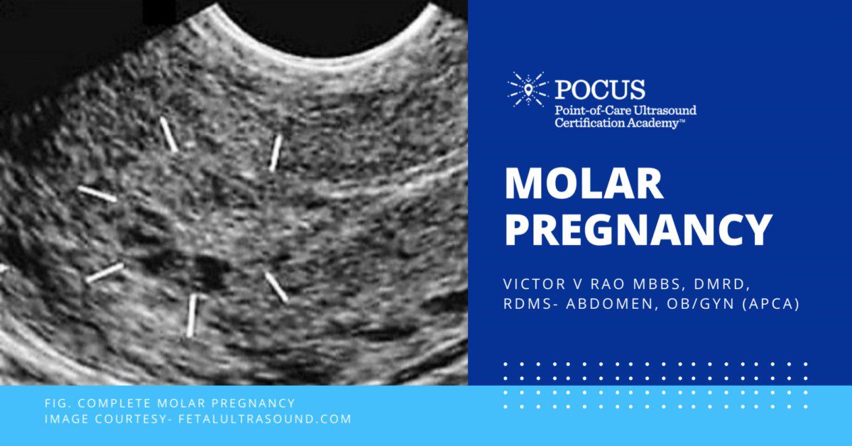 molar pregnancy 12 week scan