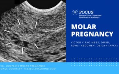 Molar Pregnancy