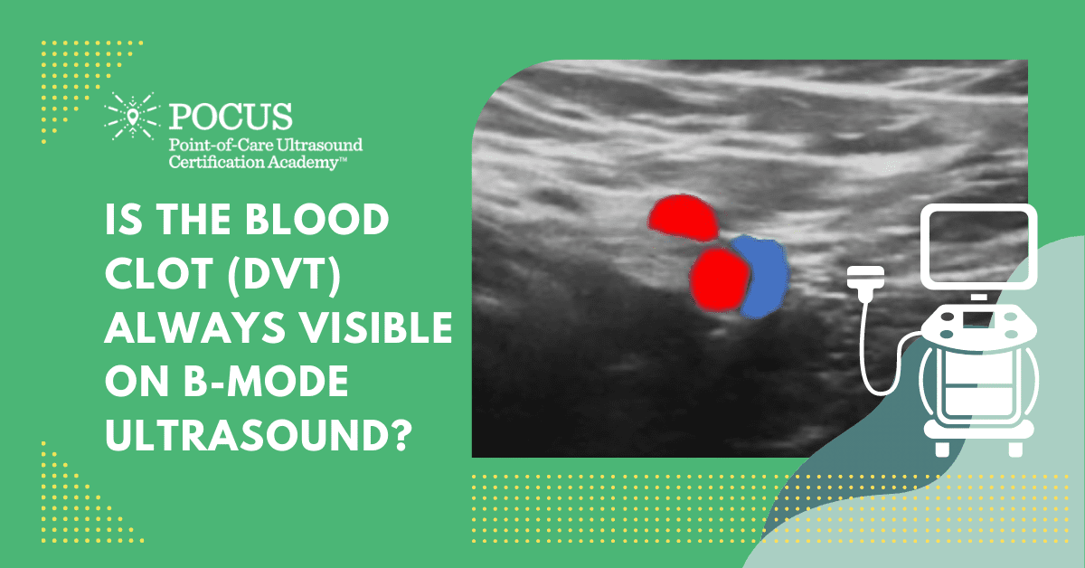 Deep Vein Thrombosis (DVT) – Is the Blood Clot (DVT) Always Visible on  B-mode Ultrasound?