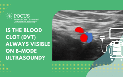 Deep Vein Thrombosis (DVT) – Is the Blood Clot (DVT) Always Visible on B-mode Ultrasound?
