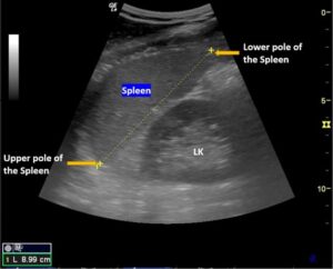 Spleen Ultrasound – How to Measure Length of the Spleen and Assess for ...