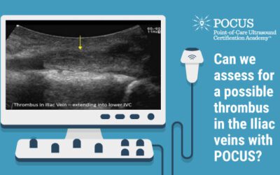 Deep Vein Thrombosis (DVT) – Review of DVT Assessment. Can we Assess for a Possible Thrombus in the Iliac Veins with POCUS?