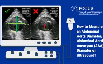 How to Measure an Abdominal Aorta Diameter/Abdominal Aortic Aneurysm (AAA) Diameter on Ultrasound?