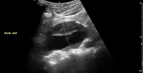 How to Measure an Abdominal Aorta Diameter/Abdominal Aortic Aneurysm ...