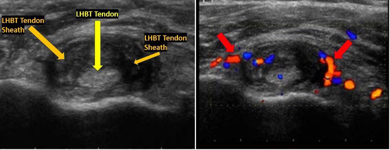 Ultrasound Assessment Of The Long Head Of The Biceps Tendon LHBT A 