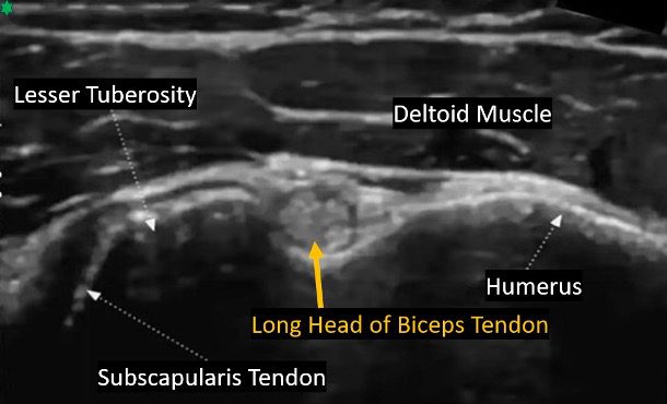 Distal Biceps Tendon Ultrasound