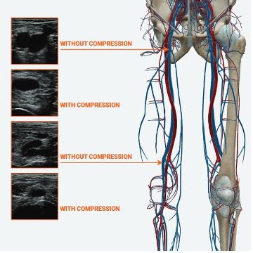 DVT anatomy and infographic