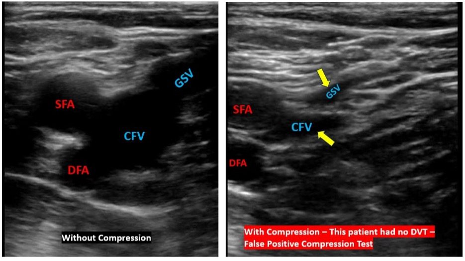 Compression vs no compression image