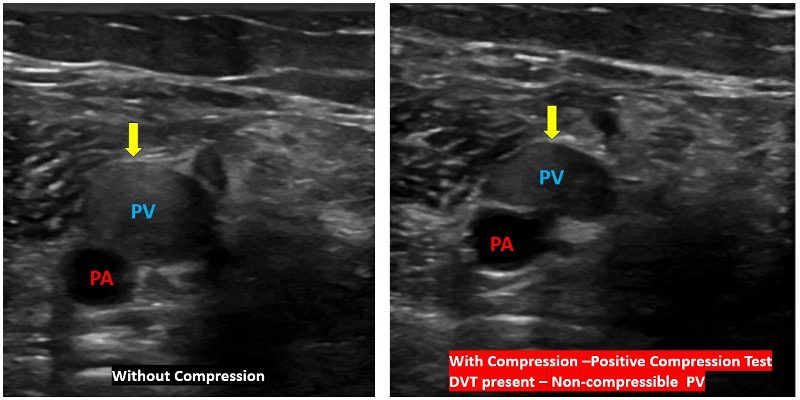 Compression vs no compression image