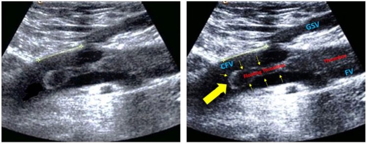 DVT of femoral vein image