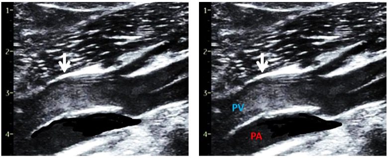 Echogenic contrast image