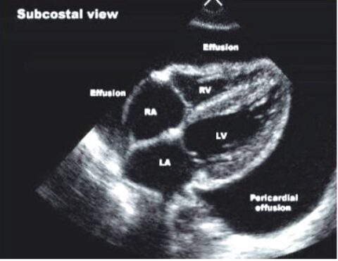 Subcodtal Pocus POCUS Evaluation of Pericardial Effusion and Tamponade - Point-of-Care ...
