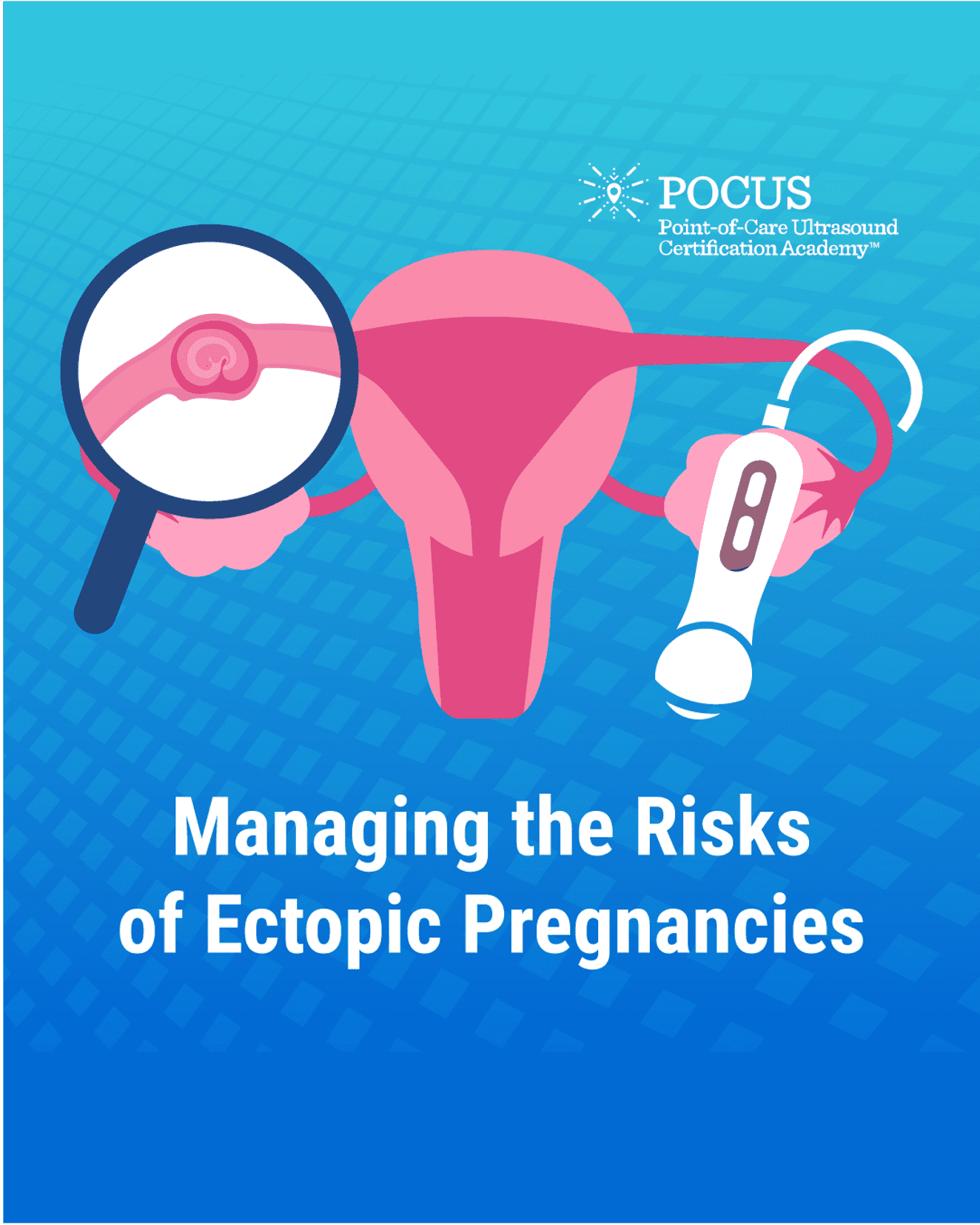 Ectopic pregnancy graphic