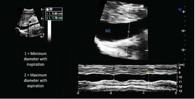 IVC M-mode view