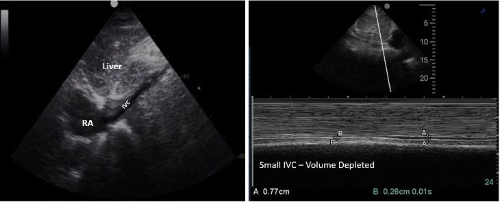 Collapsed IVC