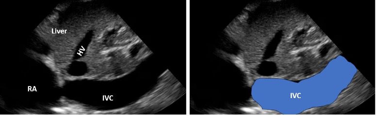 Large plethoric IVC