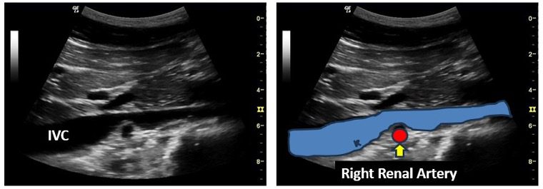 IVC renal artery view