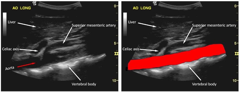 IVC abdominal aorta view