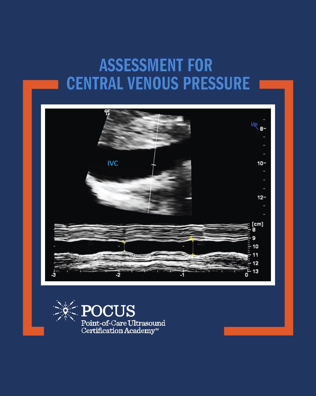 IVC infographic image