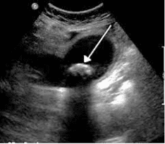 single gallstone