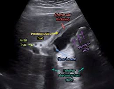multiple gallstones