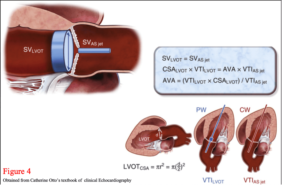 Measure Aortic Valve