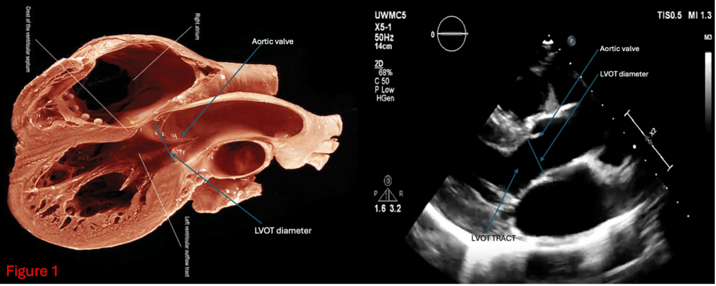 Measure LVOT Diameter