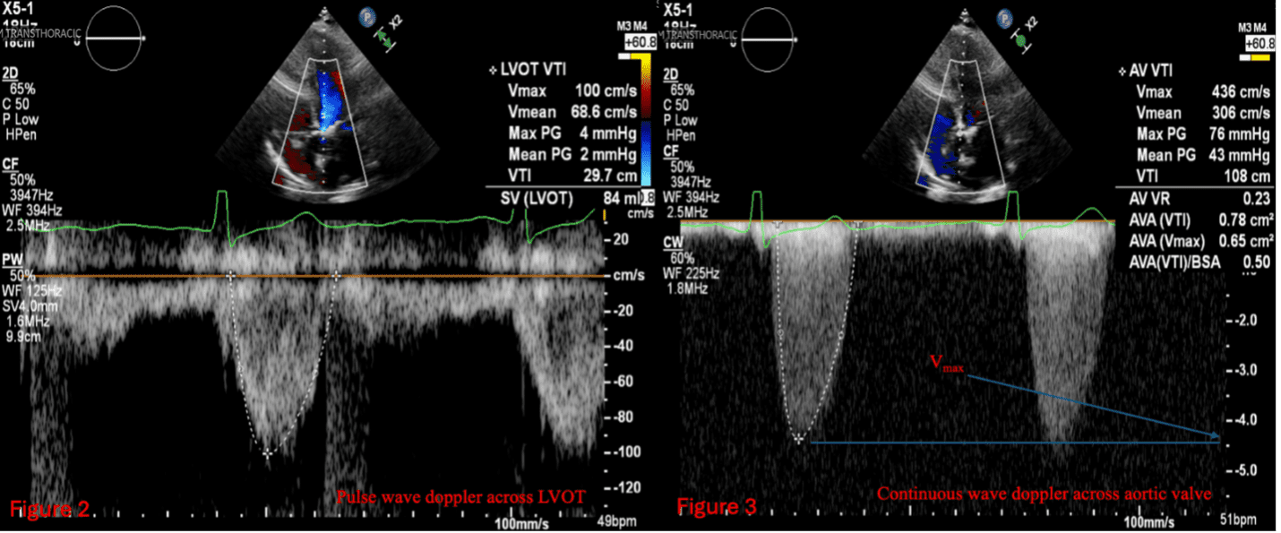 Obtain LVOT