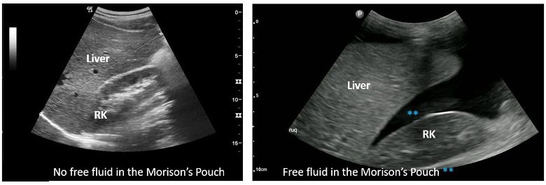 Ultrasound view of right upper quadrant